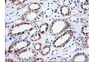 Immunohistochemical staining of paraffin-embedded Adenocarcinoma of Human ovary tissue using anti-TTC32 mouse monoclonal antibody. (TTC32 抗体)