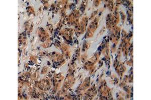 IHC-P analysis of breast cancer tissue, with DAB staining. (Fibrillin 2 抗体  (AA 1550-1791))
