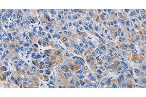 Immunohistochemistry of paraffin-embedded Human liver cancer tissue using RICTOR Polyclonal Antibody at dilution 1:50 (RICTOR 抗体)