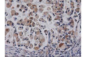 Immunohistochemical staining of paraffin-embedded Adenocarcinoma of Human colon tissue using anti-CDCP1 mouse monoclonal antibody. (CDCP1 抗体)