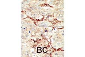 Formalin-fixed and paraffin-embedded human cancer tissue reacted with the primary antibody, which was peroxidase-conjugated to the secondary antibody, followed by DAB staining. (FGFR3 抗体  (C-Term))