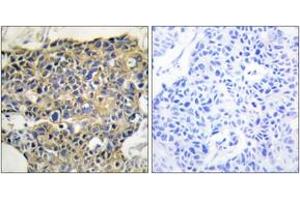 Immunohistochemistry analysis of paraffin-embedded human breast carcinoma, using EGFR (Phospho-Tyr1016) Antibody. (EGFR 抗体  (pTyr1016))