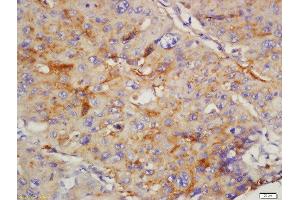 paraformaldehyde-fixed, paraffin embedded human lung carcinoma tissue; Antigen retrieval by boiling in sodium citrate buffer(pH6) for 15min; Block endogenous peroxidase by 3% hydrogen peroxide for 30 minutes; Blocking buffer (normal goat serum) at 37°C for 20min; Antibody incubation with Rabbit Anti-CD168 Polyclonal Antibody, Unconjugated  at 1:200 overnight at 4°C, followed by a conjugated secondary and DAB staining (HMMR 抗体  (AA 51-150))