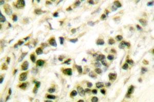 Immunohistochemical analysis of POLB polyclonal antibody  in paraffin-embedded human breast carcinoma tissue.
