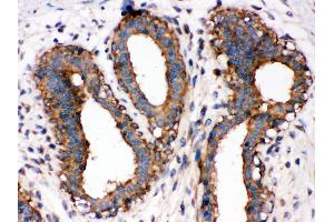Anti-NF-kB p65 antibody, IHC(P) IHC(P): Human Mammary Cancer Tissue (NF-kB p65 抗体  (Middle Region))