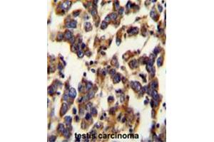 BSCL2 Antibody (N-term) immunohistochemistry analysis in formalin fixed and paraffin embedded human testis carcinoma followed by peroxidase conjugation of the secondary antibody and DAB staining. (BSCL2 抗体  (N-Term))