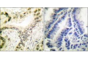 Immunohistochemistry analysis of paraffin-embedded human lung carcinoma tissue, using Histone H3 (Acetyl-Lys18) Antibody. (Histone 3 抗体  (H3K18ac))