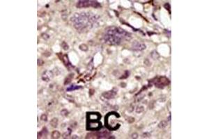 Formalin-fixed and paraffin-embedded human cancer tissue reacted with BTK polyclonal antibody  , which was peroxidase-conjugated to the secondary antibody, followed by DAB staining. (BTK 抗体  (AA 209-239))