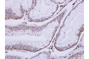 IHC-P Image Immunohistochemical analysis of paraffin-embedded human gastric cancer, using C1s, antibody at 1:500 dilution. (C1S 抗体)