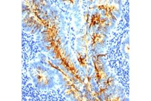 Immunohistochemical staining (Formalin-fixed paraffin-embedded sections) of human colon cancer with tag-72 monoclonal antibody, clone SPM536 . (TAG-72 抗体)