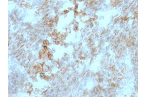 Formalin-fixed, paraffin-embedded human Colon Carcinoma stained with CD147 Mouse Monoclonal Antibody (BSG/963). (CD147 抗体)