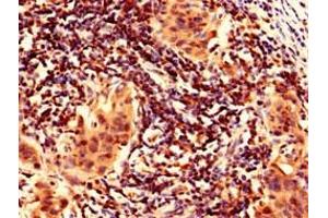 Immunohistochemistry analysis of human bladder cancer using ABIN7165446 at dilution of 1:100 (FAM171B 抗体  (AA 59-353))