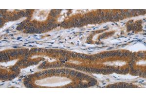 Immunohistochemistry of paraffin-embedded Human colon cancer tissue using PDGFA Polyclonal Antibody at dilution 1:70 (PDGFA 抗体)