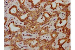 IHC image of ABIN7154988 diluted at 1:300 and staining in paraffin-embedded human liver cancer performed on a Leica BondTM system. (HBG2 抗体  (AA 2-147))