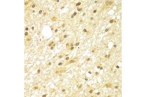 Immunohistochemistry of paraffin-embedded human brain cancer using TBL1XR1 antibody (ABIN5975754) at dilution of 1/100 (40x lens). (TBL1XR1 抗体)