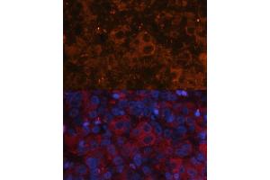 Immunofluorescence analysis of human liver cancer using Alpha-Fetoprotein (Alpha-Fetoprotein (AFP)) antibody (ABIN6129175, ABIN6136616, ABIN6136618 and ABIN6215038) at dilution of 1:100. (alpha Fetoprotein 抗体  (AA 360-609))