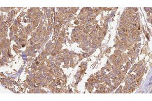 ABIN6274664 at 1/100 staining Human Melanoma tissue by IHC-P. (CYTL1 抗体)