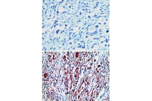 Immunohistochemical analysis of RXFP1 in paraffin-embedded formalin-fixed human stomach tumor tissue using an isotype control (top) and RXFP1 polyclonal antibody  (bottom) at 1 : 100. (RXFP1 抗体  (AA 694-732))