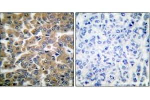 Immunohistochemistry analysis of paraffin-embedded human breast carcinoma tissue, using GR (Ab-211) Antibody. (GR (AA 181-230) 抗体)