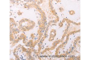 Immunohistochemistry of Human thyroid cancer using F7 Polyclonal Antibody at dilution of 1:40 (Factor VII 抗体)