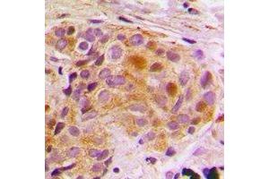 Immunohistochemical analysis of STAT5B staining in human breast cancer formalin fixed paraffin embedded tissue section. (STAT5B 抗体)