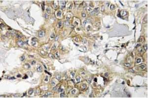 Immunohistochemistry analyzes of HER2 antibody in paraffin-embedded human breast carcinoma tissue. (ErbB2/Her2 抗体)