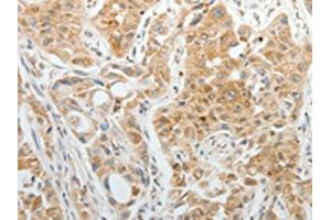 The image on the left is immunohistochemistry of paraffin-embedded Human lung cancer tissue using ABIN7192952(TTF2 Antibody) at dilution 1/5, on the right is treated with synthetic peptide. (TTF2 抗体)
