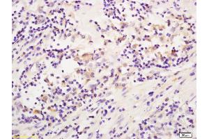 Formalin-fixed and paraffin embedded human colon carcinoma labeled with Anti-CD19 Polyclonal Antibody, Unconjugated (ABIN1387313) at 1:200 followed by conjugation to the secondary antibody and DAB staining. (CD19 抗体  (AA 151-250))