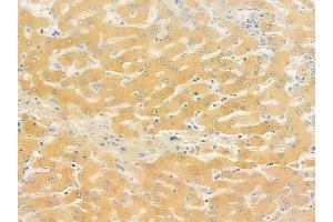 ABIN6261200 and ABIN6278823 at 1/100 staining human hepatocellular carcinoma by IHC-P.