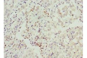 Immunohistochemistry of paraffin-embedded human lung cancer using ABIN7145588 at dilution of 1:100 (BAAT 抗体  (AA 309-418))