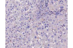 ABIN6267226 at 1/200 staining human liver cancer tissue sections by IHC-P. (IKBKB 抗体  (pTyr188))