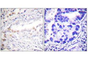 Immunohistochemistry analysis of paraffin-embedded human lung carcinoma tissue using Uba2 antibody. (UBA2 抗体  (C-Term))