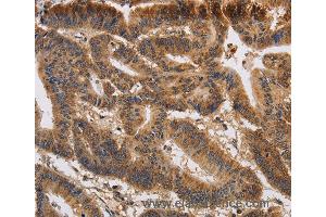 Immunohistochemistry of Human colon cancer using KCNK9 Polyclonal Antibody at dilution of 1:40 (KCNK9 抗体)