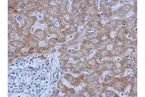 IHC-P Image Immunohistochemical analysis of paraffin-embedded human hepatoma, using IL13 Receptor alpha 1, antibody at 1:500 dilution. (IL13 Receptor alpha 1 抗体)