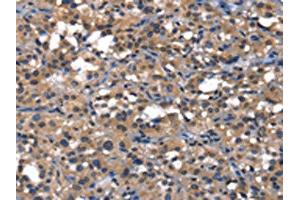 The image on the left is immunohistochemistry of paraffin-embedded Human thyroid cancer tissue using ABIN7129820(IGFBP5 Antibody) at dilution 1/25, on the right is treated with fusion protein. (IGFBP5 抗体)