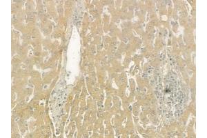 ABIN6265260 and ABIN6276508 at 1/100 staining human hepatocellular carcinoma by IHC-P.