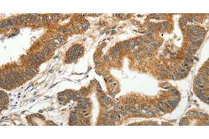 Immunohistochemistry of paraffin-embedded Human colon cancer tissue using SLC4A4 Polyclonal Antibody at dilution 1:50 (SLC4A4 抗体)