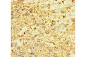 Immunohistochemistry of paraffin-embedded human melanoma using ABIN7172513 at dilution of 1:100 (E2F1 抗体  (AA 133-362))