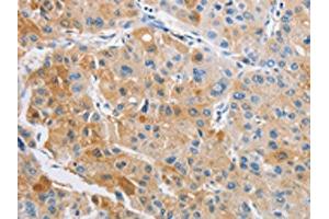 The image on the left is immunohistochemistry of paraffin-embedded Human liver cancer tissue using ABIN7128493(ARHGAP5 Antibody) at dilution 1/25, on the right is treated with fusion protein. (ARHGAP5 抗体)