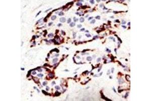 IHC analysis of FFPE human breast carcinoma tissue stained with the SUV39H2 antibody (SUV39H2 抗体  (AA 93-122))