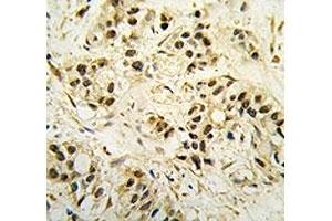 IHC analysis of FFPE human breast carcinoma tissue stained with CDC2 antibody