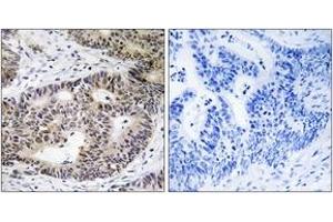 Immunohistochemistry analysis of paraffin-embedded human colon carcinoma tissue, using ZFYVE19 Antibody. (ZFYVE19 抗体  (AA 311-360))