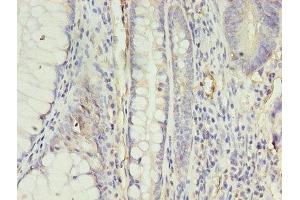 Immunohistochemistry of paraffin-embedded human colon cancer using ABIN7144394 at dilution of 1:100 (Apelin Receptor 抗体  (AA 309-380))