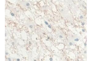 Detection of IL10 in Human Glioma Tissue using Monoclonal Antibody to Interleukin 10 (IL10) (IL-10 抗体  (AA 1-178))