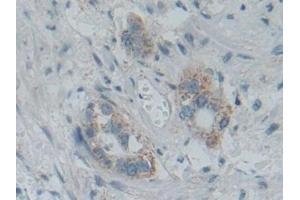 Detection of SMAD5 in Human Pancreatic cancer Tissue using Polyclonal Antibody to SMAD family member 5 (SMAD5) (SMAD5 抗体  (AA 210-464))