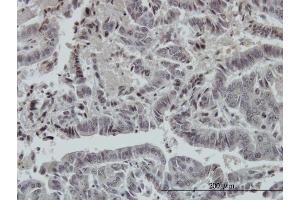 Immunoperoxidase of monoclonal antibody to FOXO3A on formalin-fixed paraffin-embedded human colon adenocarcinoma. (FOXO3 抗体  (AA 361-460))