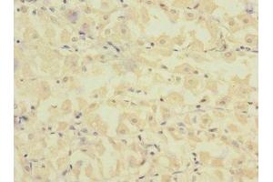 Immunohistochemistry of paraffin-embedded human gastric cancer using ABIN7152656 at dilution of 1:100 (FCRL2 抗体  (AA 20-100))