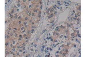 Detection of IFNa/bR2 in Human Breast cancer Tissue using Polyclonal Antibody to Interferon Alpha/Beta Receptor 2 (IFNa/bR2)