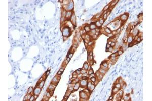 Formalin-fixed, paraffin-embedded human Colon Carcinoma stained with Cytokeratin 20 (KRT20) Mouse Monoclonal Antibody (KRT20/1991). (KRT20 抗体  (AA 196-323))