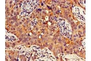Immunohistochemistry of paraffin-embedded human pancreatic cancer using ABIN7154741 at dilution of 1:100 (GNB4 抗体  (AA 105-185))